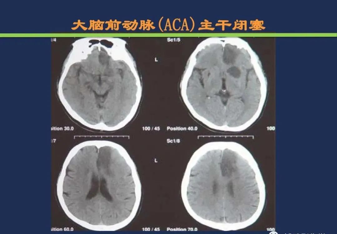 影像PPT - 从梗死部位推测责任血管:脑血管解剖-58 影像PPT - 从梗死部位推测责任血管:脑血管解剖-58