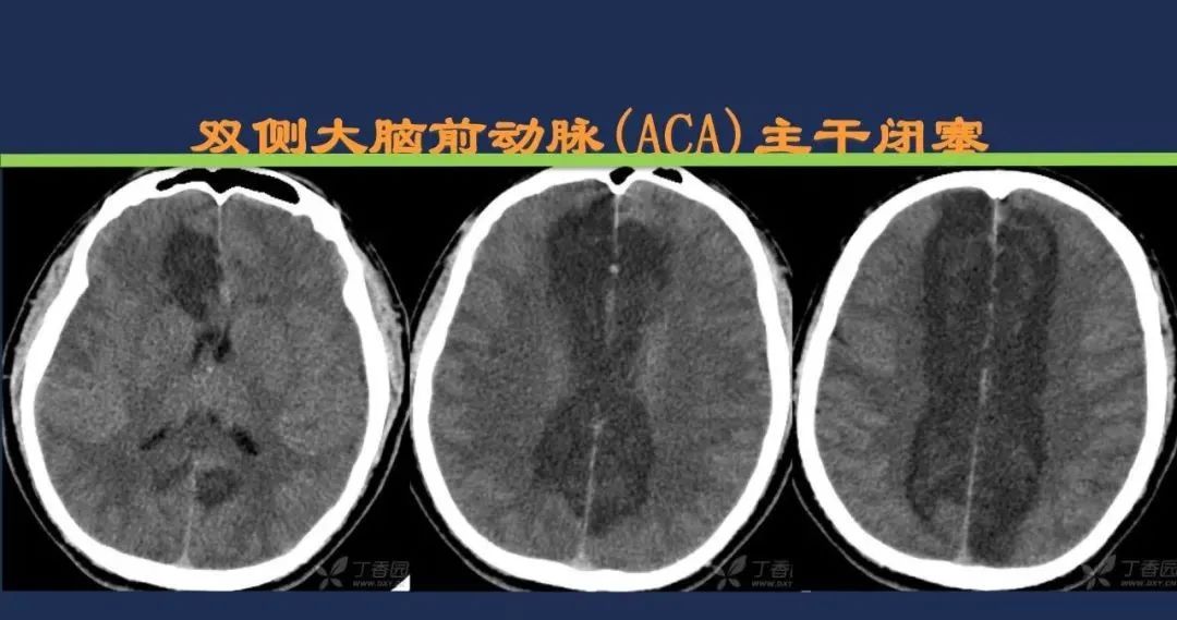 影像PPT - 从梗死部位推测责任血管:脑血管解剖-59 影像PPT - 从梗死部位推测责任血管:脑血管解剖-59