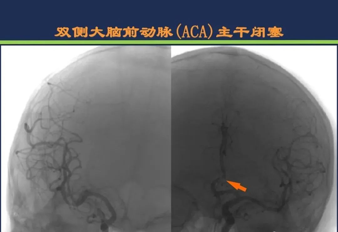 影像PPT - 从梗死部位推测责任血管:脑血管解剖-60 影像PPT - 从梗死部位推测责任血管:脑血管解剖-60