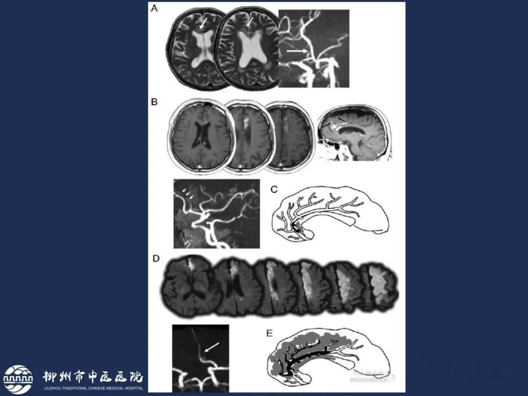 影像PPT - 从梗死部位推测责任血管:脑血管解剖-62 影像PPT - 从梗死部位推测责任血管:脑血管解剖-62