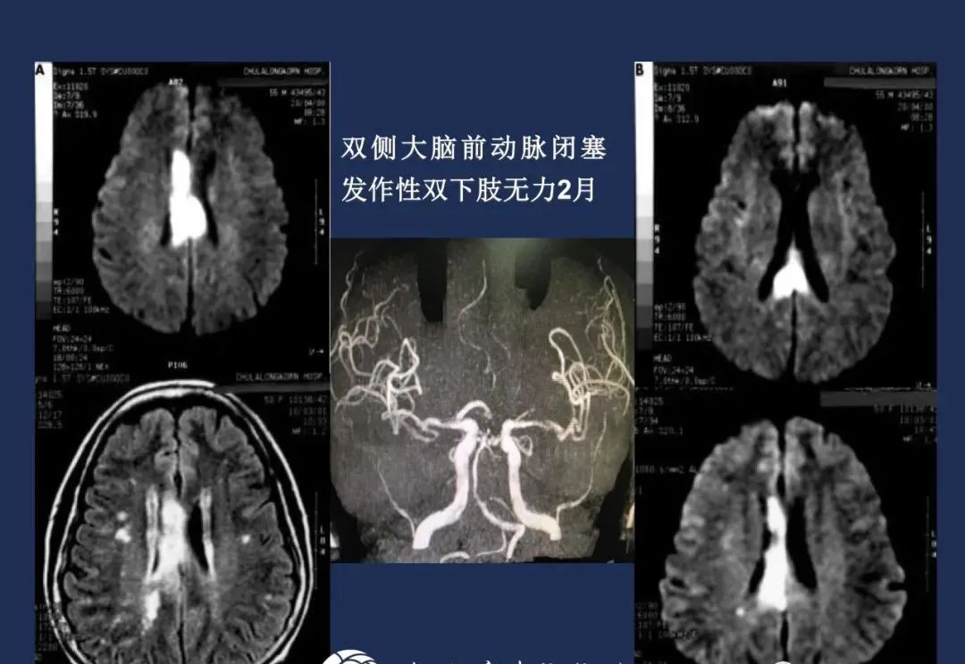 影像PPT - 从梗死部位推测责任血管:脑血管解剖-63 影像PPT - 从梗死部位推测责任血管:脑血管解剖-63