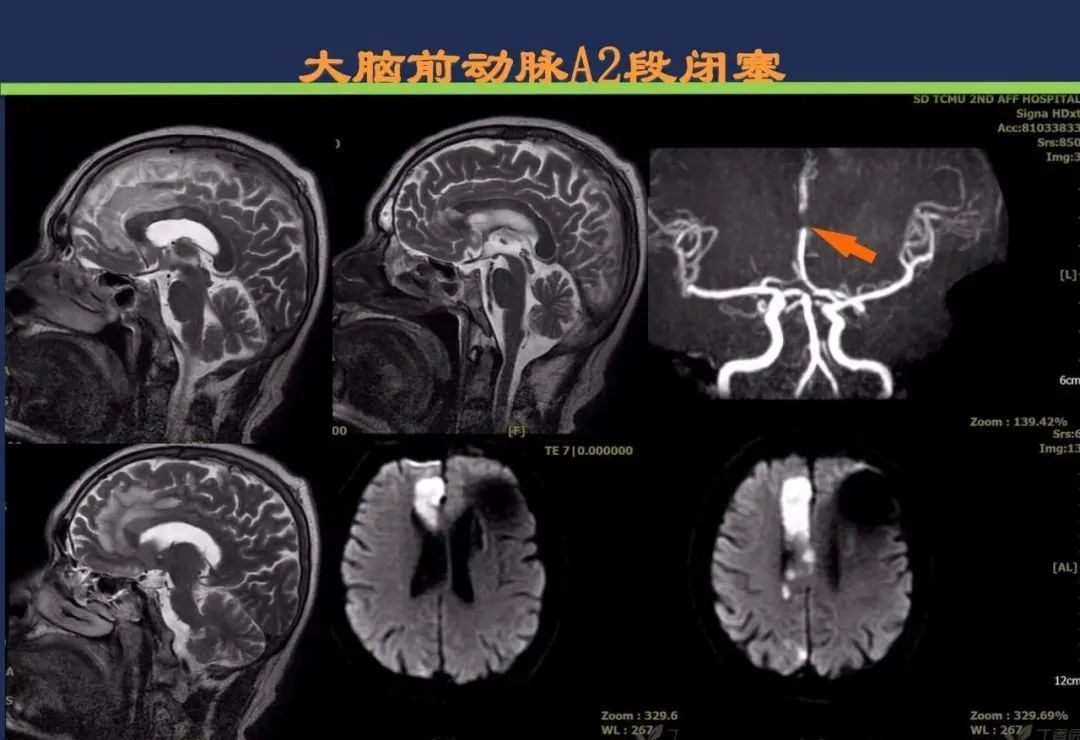 影像PPT - 从梗死部位推测责任血管:脑血管解剖-64 影像PPT - 从梗死部位推测责任血管:脑血管解剖-64