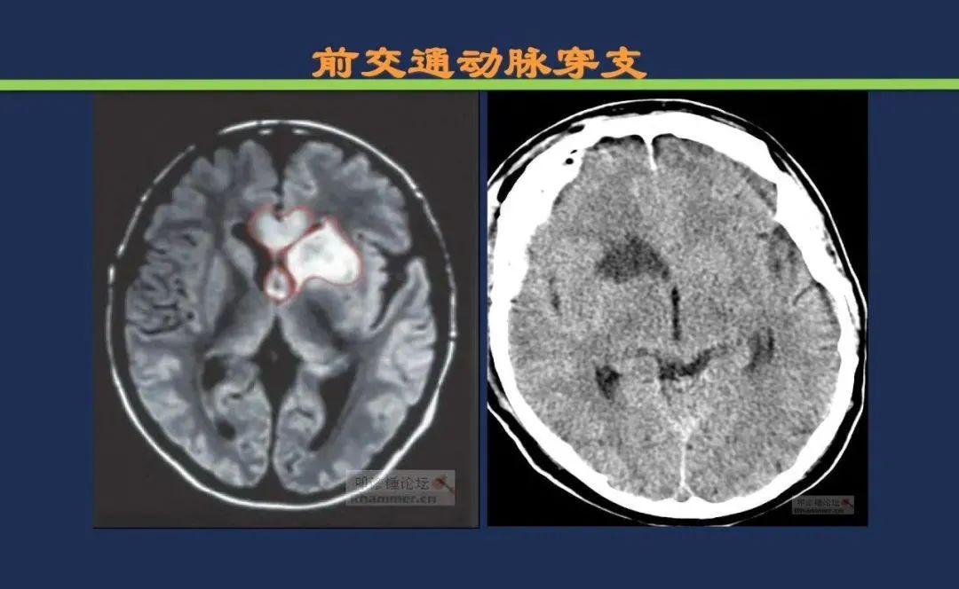 影像PPT - 从梗死部位推测责任血管:脑血管解剖-65 影像PPT - 从梗死部位推测责任血管:脑血管解剖-65