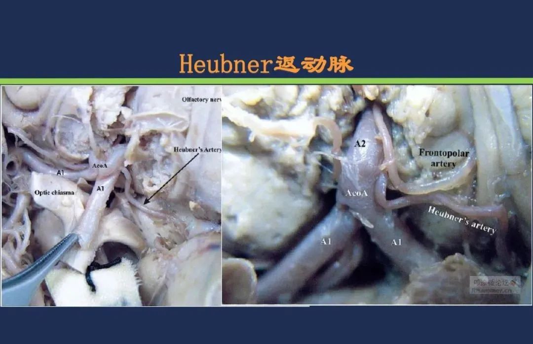 影像PPT - 从梗死部位推测责任血管:脑血管解剖-67 影像PPT - 从梗死部位推测责任血管:脑血管解剖-67