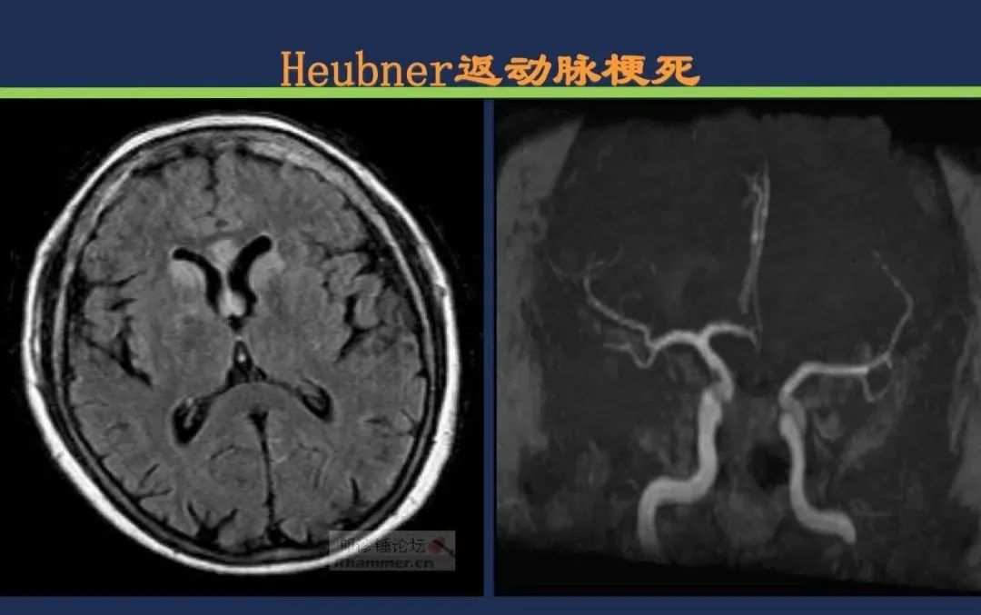 影像PPT - 从梗死部位推测责任血管:脑血管解剖-68 影像PPT - 从梗死部位推测责任血管:脑血管解剖-68