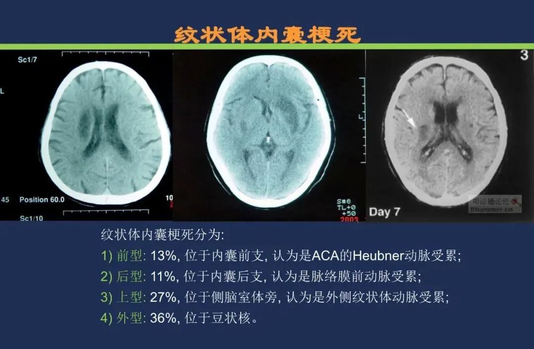 影像PPT - 从梗死部位推测责任血管:脑血管解剖-69 影像PPT - 从梗死部位推测责任血管:脑血管解剖-69