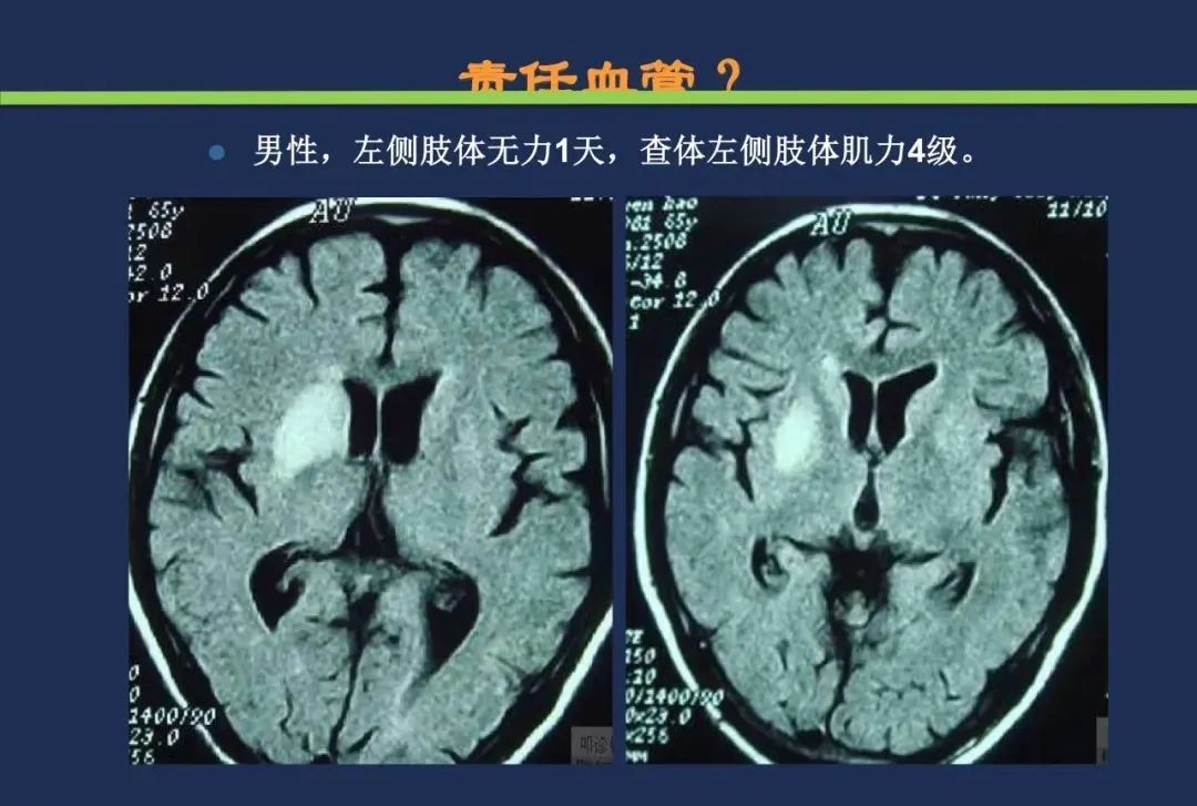影像PPT - 从梗死部位推测责任血管:脑血管解剖-71 影像PPT - 从梗死部位推测责任血管:脑血管解剖-71