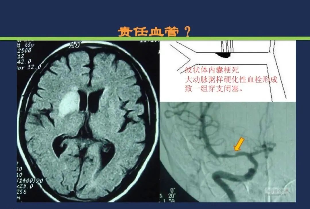 影像PPT - 从梗死部位推测责任血管:脑血管解剖-72 影像PPT - 从梗死部位推测责任血管:脑血管解剖-72