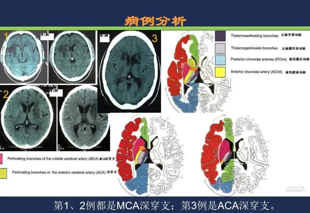 影像PPT - 从梗死部位推测责任血管:脑血管解剖-73 影像PPT - 从梗死部位推测责任血管:脑血管解剖-73