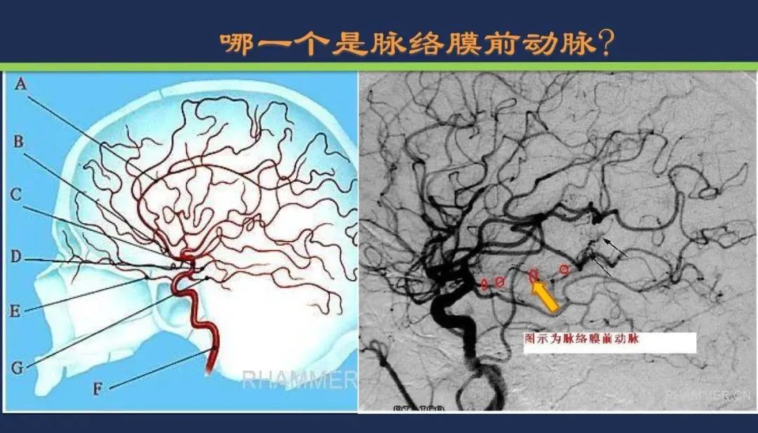 影像PPT - 从梗死部位推测责任血管:脑血管解剖-76 影像PPT - 从梗死部位推测责任血管:脑血管解剖-76
