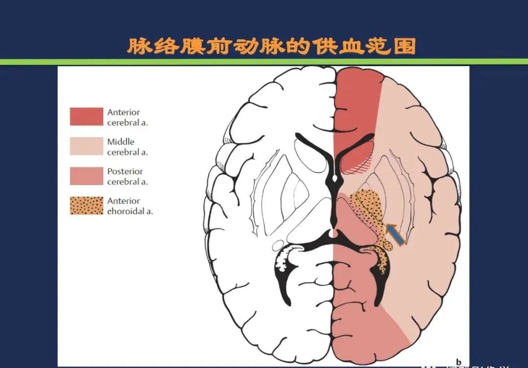影像PPT - 从梗死部位推测责任血管:脑血管解剖-78 影像PPT - 从梗死部位推测责任血管:脑血管解剖-78