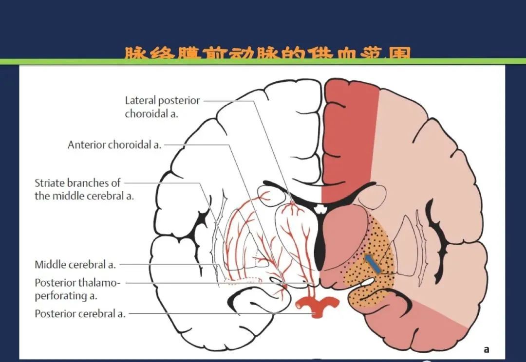 影像PPT - 从梗死部位推测责任血管:脑血管解剖-79 影像PPT - 从梗死部位推测责任血管:脑血管解剖-79