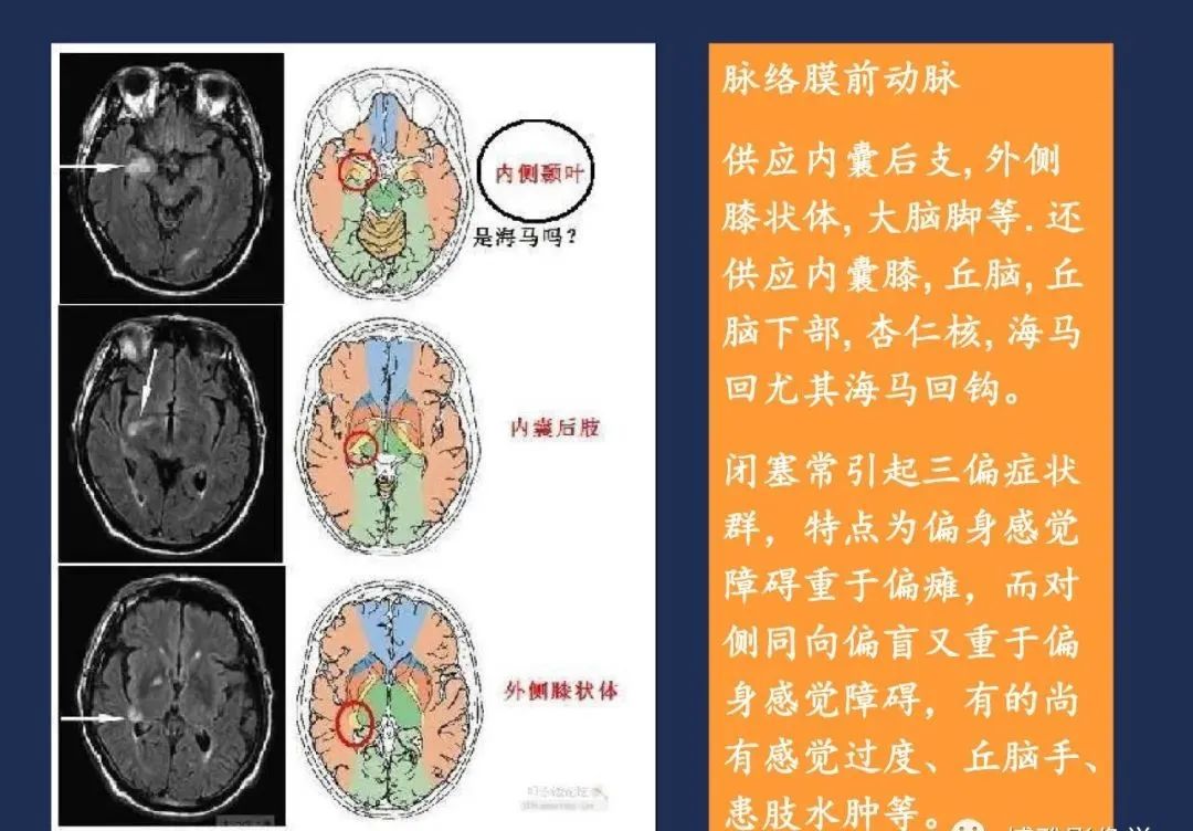 影像PPT - 从梗死部位推测责任血管:脑血管解剖-80 影像PPT - 从梗死部位推测责任血管:脑血管解剖-80