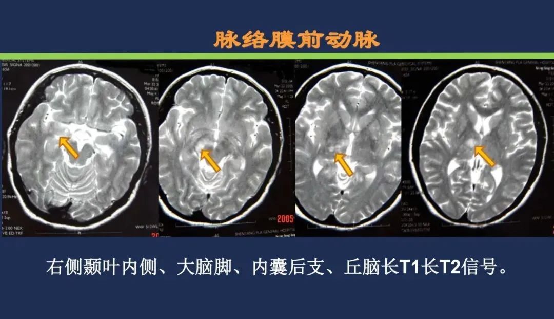影像PPT - 从梗死部位推测责任血管:脑血管解剖-81 影像PPT - 从梗死部位推测责任血管:脑血管解剖-81