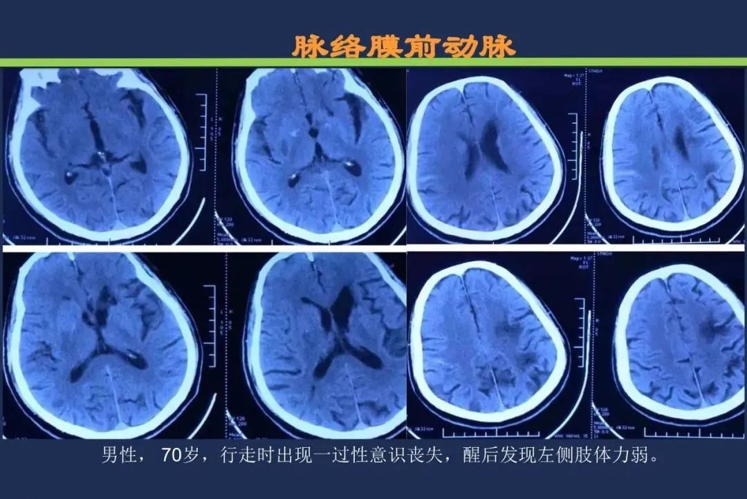 影像PPT - 从梗死部位推测责任血管:脑血管解剖-82 影像PPT - 从梗死部位推测责任血管:脑血管解剖-82