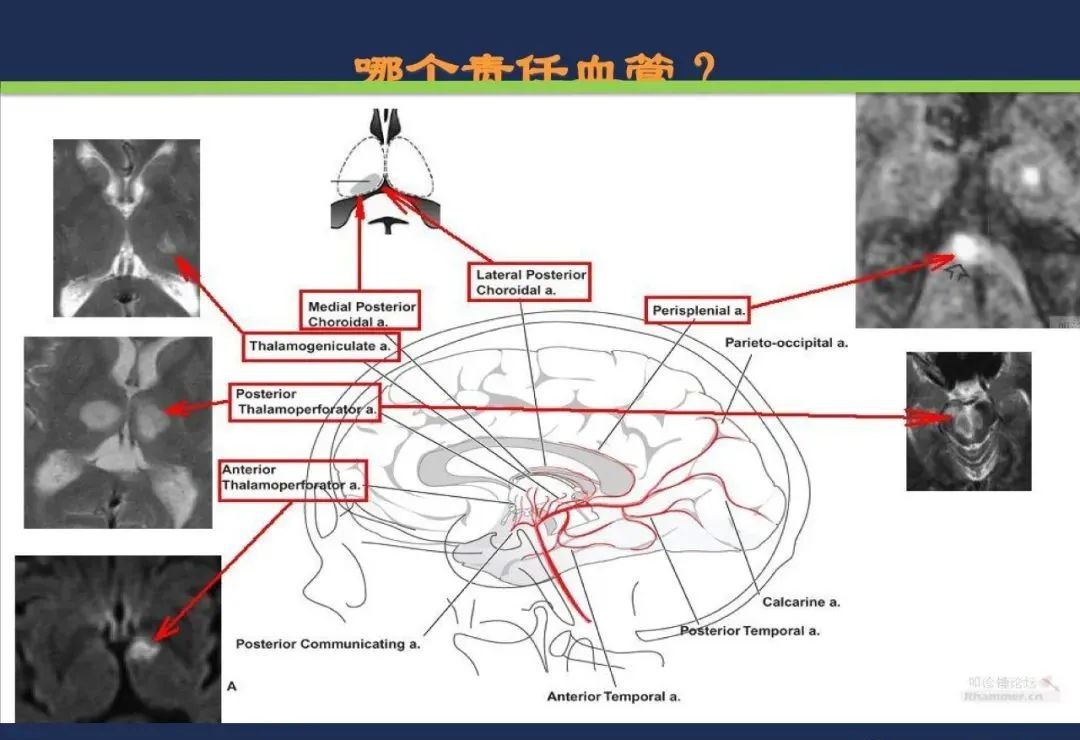 影像PPT - 从梗死部位推测责任血管:脑血管解剖-89 影像PPT - 从梗死部位推测责任血管:脑血管解剖-89
