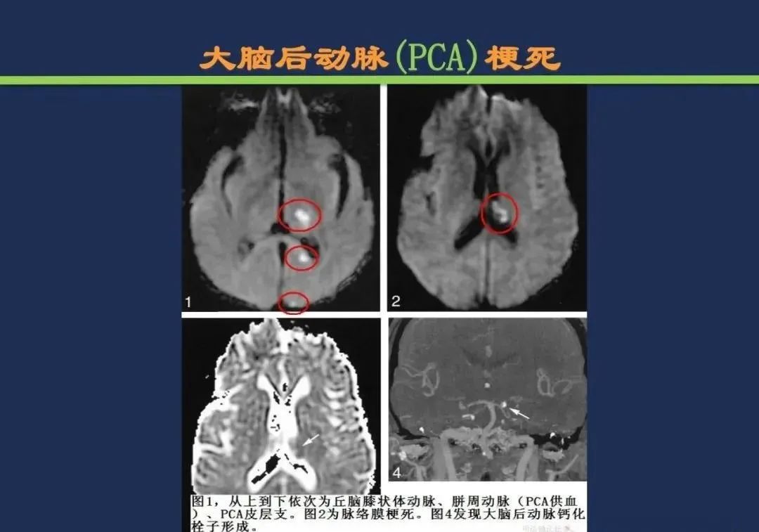影像PPT - 从梗死部位推测责任血管:脑血管解剖-91 影像PPT - 从梗死部位推测责任血管:脑血管解剖-91