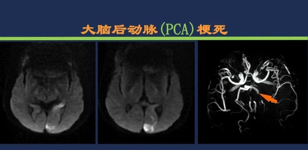 影像PPT - 从梗死部位推测责任血管:脑血管解剖-92 影像PPT - 从梗死部位推测责任血管:脑血管解剖-92