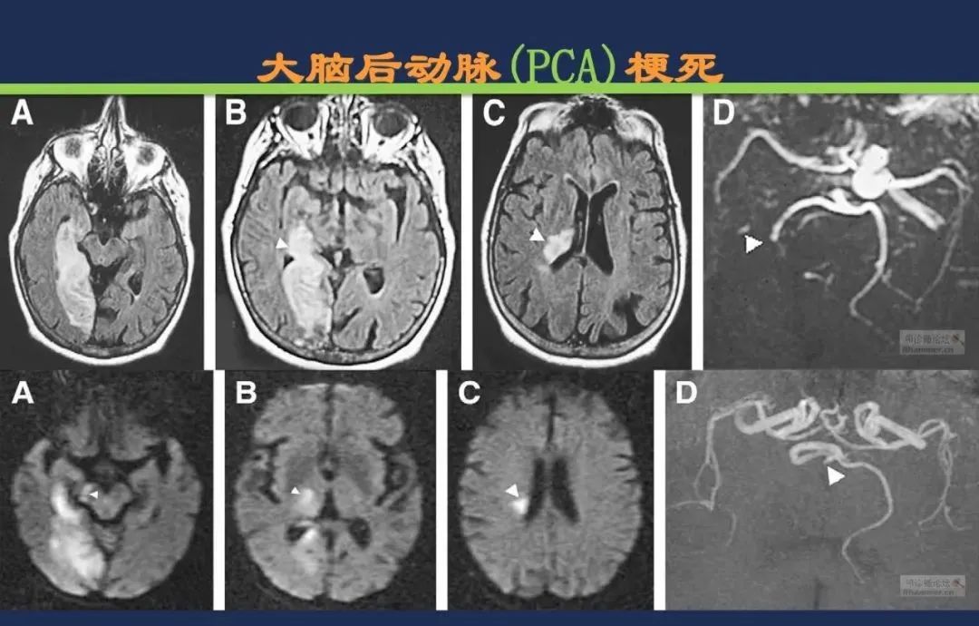 影像PPT - 从梗死部位推测责任血管:脑血管解剖-93 影像PPT - 从梗死部位推测责任血管:脑血管解剖-93
