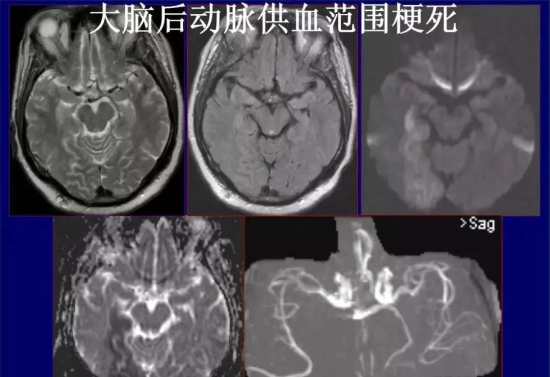 影像PPT - 从梗死部位推测责任血管:脑血管解剖-95 影像PPT - 从梗死部位推测责任血管:脑血管解剖-95