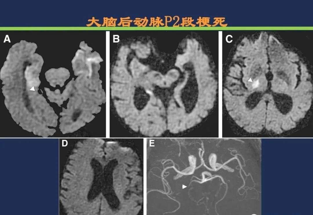 影像PPT - 从梗死部位推测责任血管:脑血管解剖-96 影像PPT - 从梗死部位推测责任血管:脑血管解剖-96