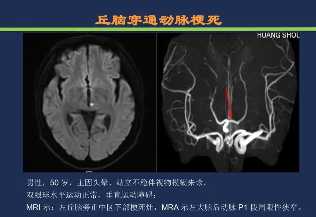 影像PPT - 从梗死部位推测责任血管:脑血管解剖-101 影像PPT - 从梗死部位推测责任血管:脑血管解剖-101
