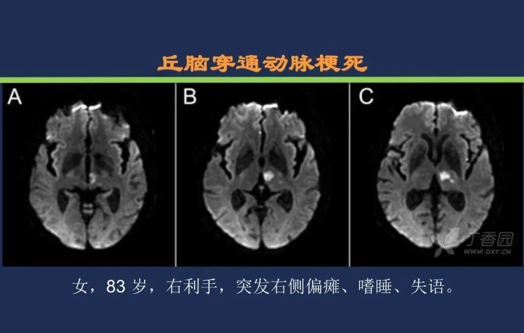 影像PPT - 从梗死部位推测责任血管:脑血管解剖-102 影像PPT - 从梗死部位推测责任血管:脑血管解剖-102