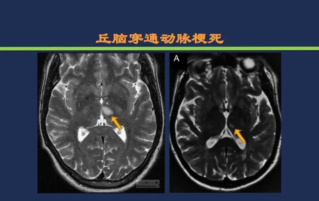 影像PPT - 从梗死部位推测责任血管:脑血管解剖-103 影像PPT - 从梗死部位推测责任血管:脑血管解剖-103
