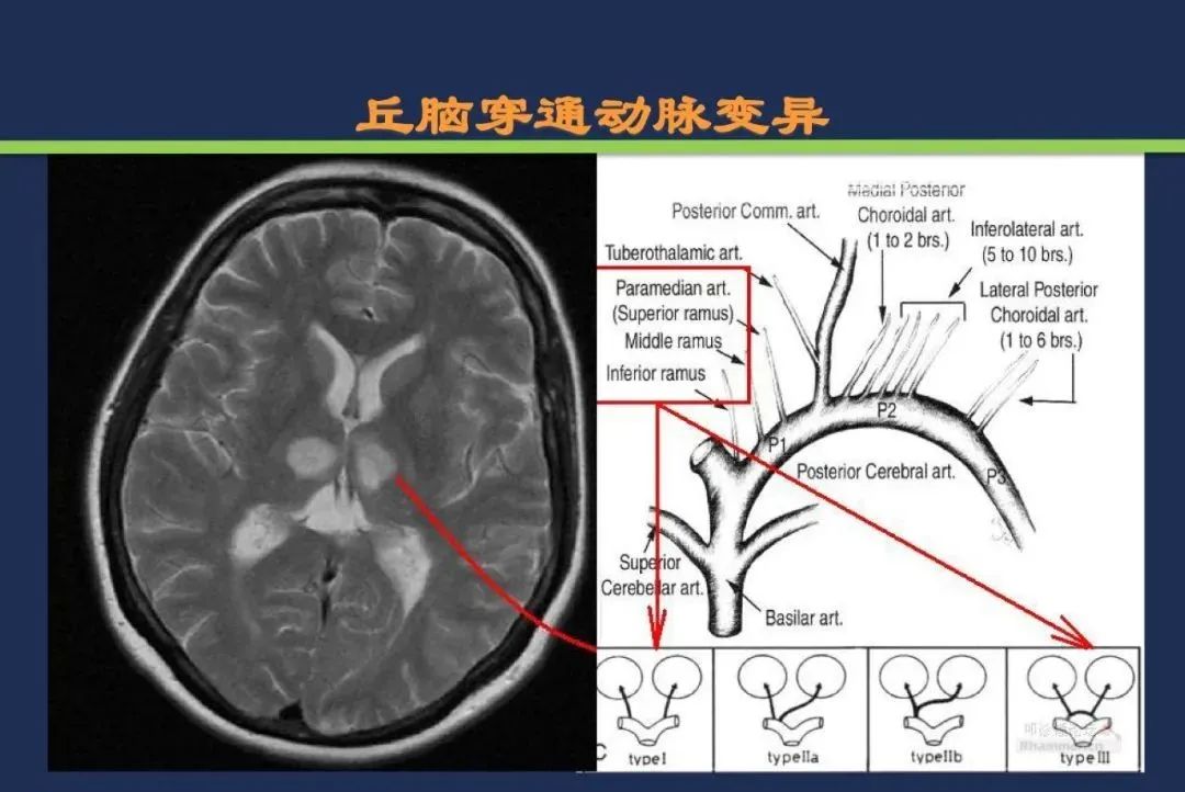 影像PPT - 从梗死部位推测责任血管:脑血管解剖-104 影像PPT - 从梗死部位推测责任血管:脑血管解剖-104