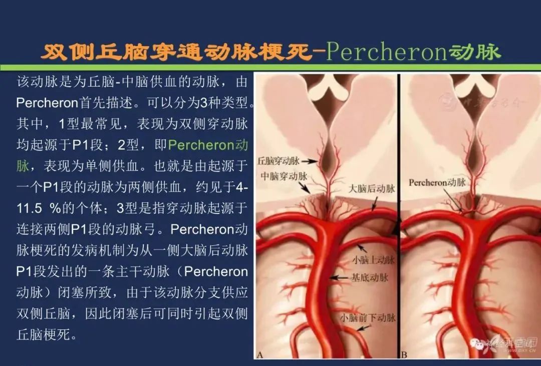 影像PPT - 从梗死部位推测责任血管:脑血管解剖-105 影像PPT - 从梗死部位推测责任血管:脑血管解剖-105