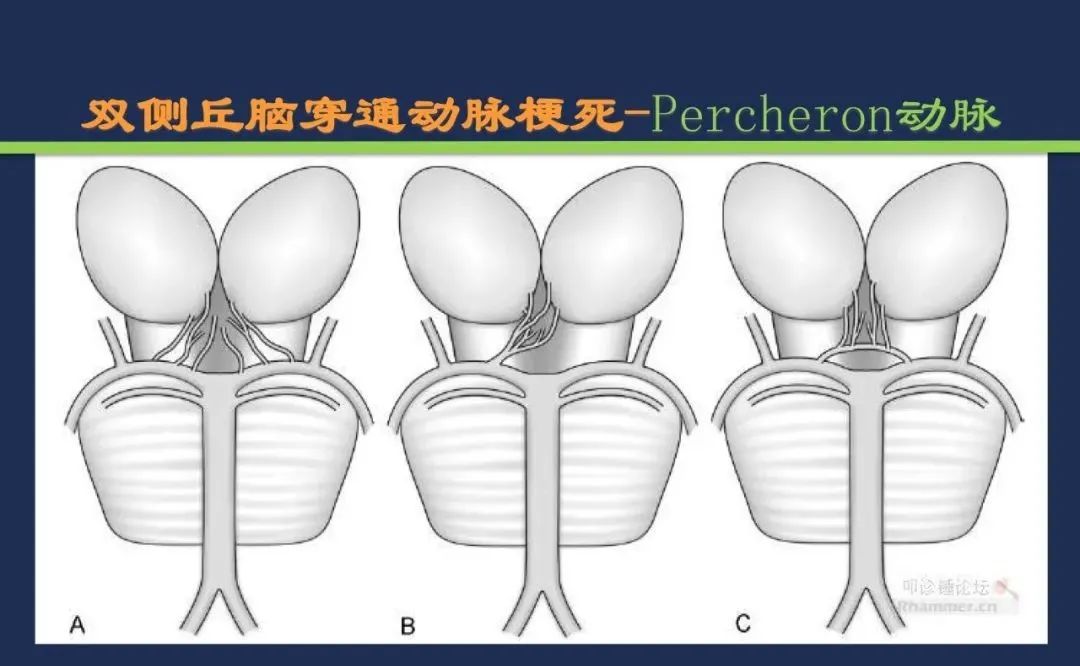 影像PPT - 从梗死部位推测责任血管:脑血管解剖-106 影像PPT - 从梗死部位推测责任血管:脑血管解剖-106