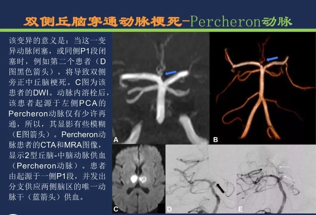 影像PPT - 从梗死部位推测责任血管:脑血管解剖-107 影像PPT - 从梗死部位推测责任血管:脑血管解剖-107