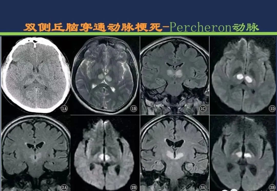 影像PPT - 从梗死部位推测责任血管:脑血管解剖-108 影像PPT - 从梗死部位推测责任血管:脑血管解剖-108