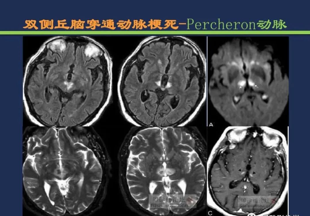 影像PPT - 从梗死部位推测责任血管:脑血管解剖-109 影像PPT - 从梗死部位推测责任血管:脑血管解剖-109
