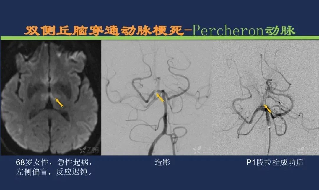 影像PPT - 从梗死部位推测责任血管:脑血管解剖-110 影像PPT - 从梗死部位推测责任血管:脑血管解剖-110