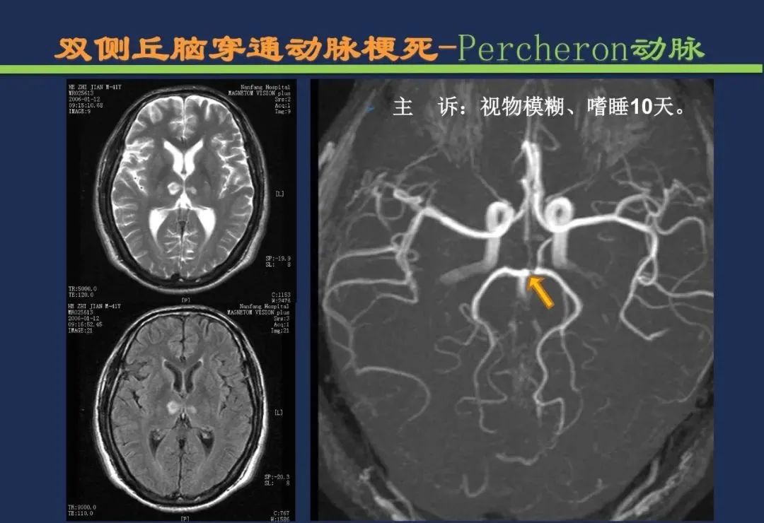 影像PPT - 从梗死部位推测责任血管:脑血管解剖-111 影像PPT - 从梗死部位推测责任血管:脑血管解剖-111
