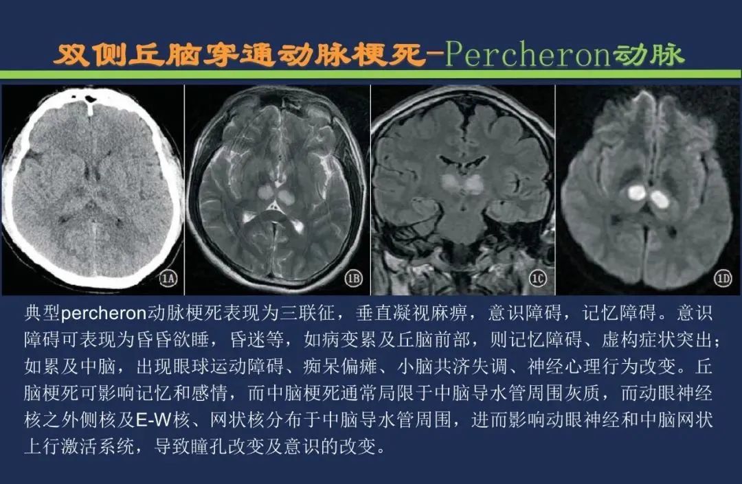 影像PPT - 从梗死部位推测责任血管:脑血管解剖-112 影像PPT - 从梗死部位推测责任血管:脑血管解剖-112