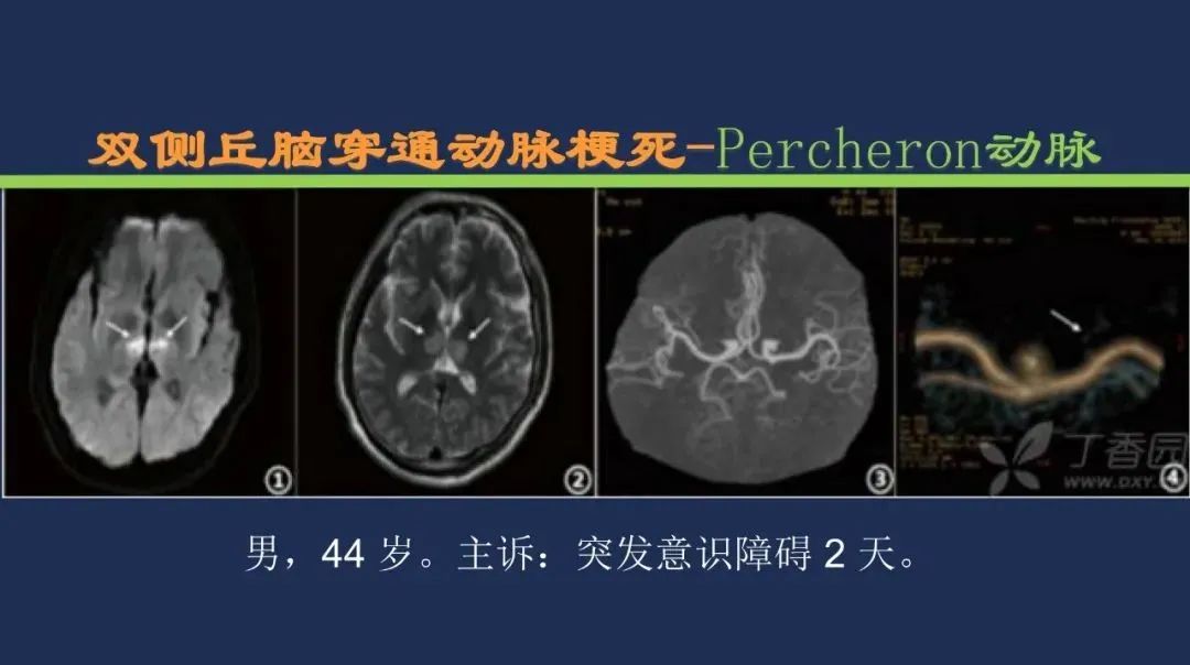 影像PPT - 从梗死部位推测责任血管:脑血管解剖-113 影像PPT - 从梗死部位推测责任血管:脑血管解剖-113