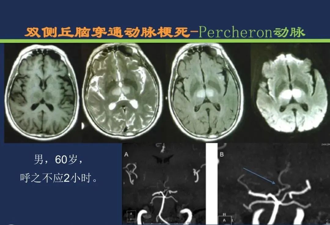 影像PPT - 从梗死部位推测责任血管:脑血管解剖-114 影像PPT - 从梗死部位推测责任血管:脑血管解剖-114