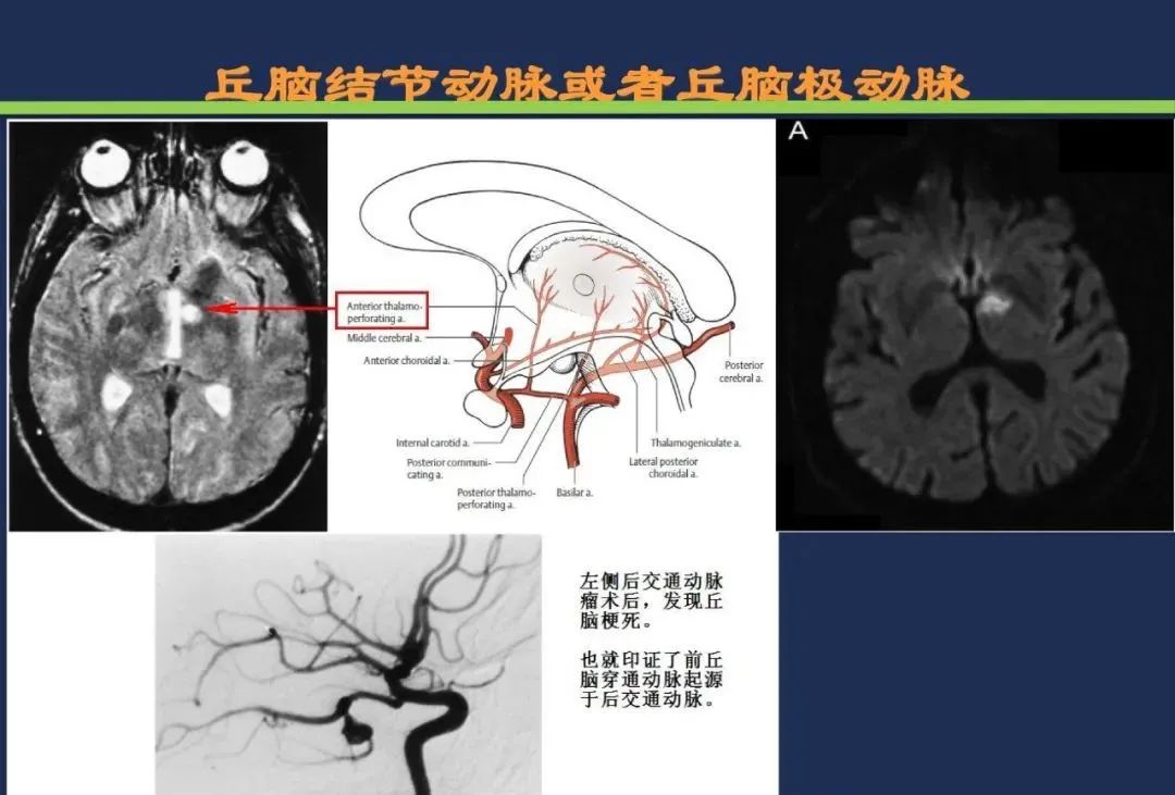 影像PPT - 从梗死部位推测责任血管:脑血管解剖-115 影像PPT - 从梗死部位推测责任血管:脑血管解剖-115