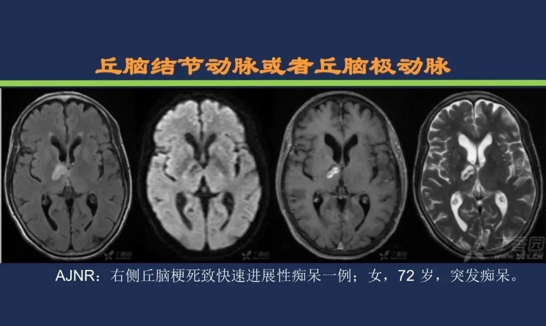 影像PPT - 从梗死部位推测责任血管:脑血管解剖-116 影像PPT - 从梗死部位推测责任血管:脑血管解剖-116