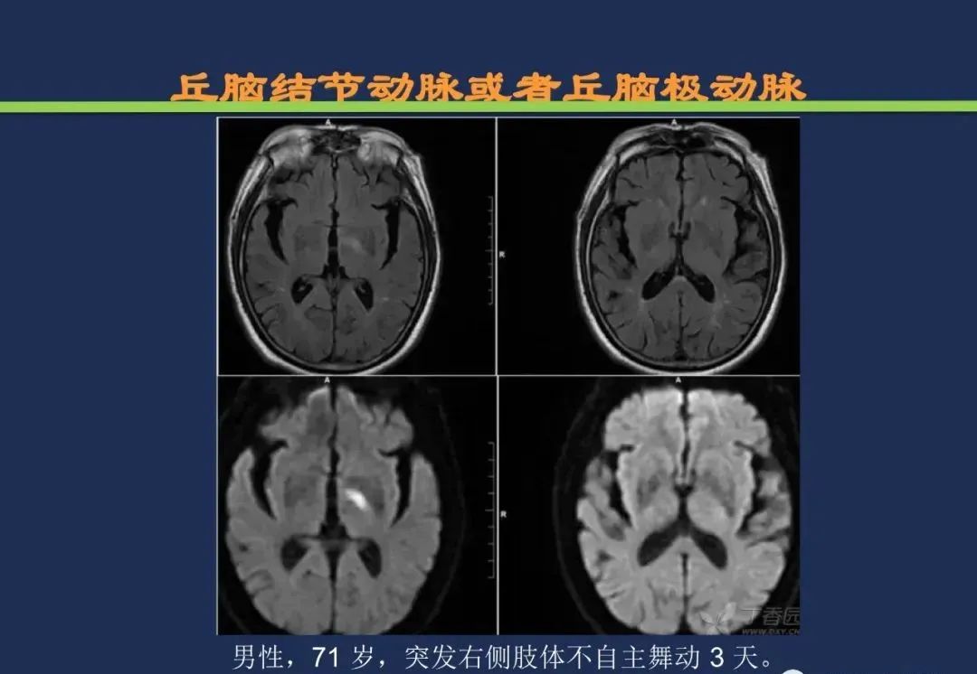 影像PPT - 从梗死部位推测责任血管:脑血管解剖-117 影像PPT - 从梗死部位推测责任血管:脑血管解剖-117