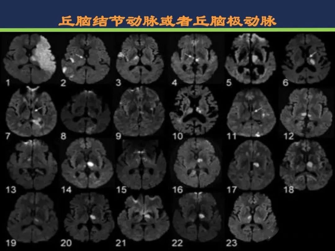 影像PPT - 从梗死部位推测责任血管:脑血管解剖-118 影像PPT - 从梗死部位推测责任血管:脑血管解剖-118