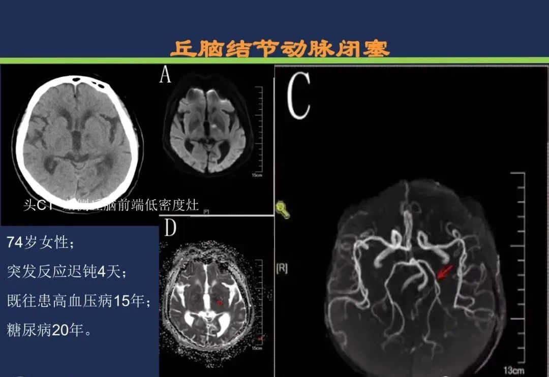 影像PPT - 从梗死部位推测责任血管:脑血管解剖-119 影像PPT - 从梗死部位推测责任血管:脑血管解剖-119