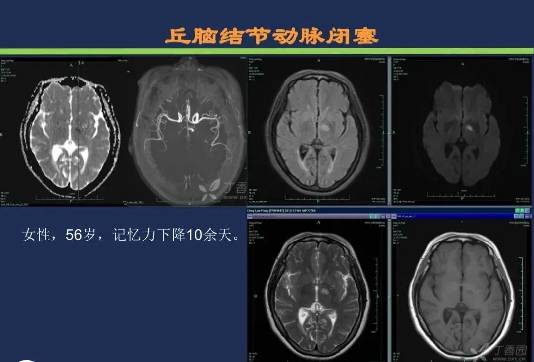 影像PPT - 从梗死部位推测责任血管:脑血管解剖-120 影像PPT - 从梗死部位推测责任血管:脑血管解剖-120