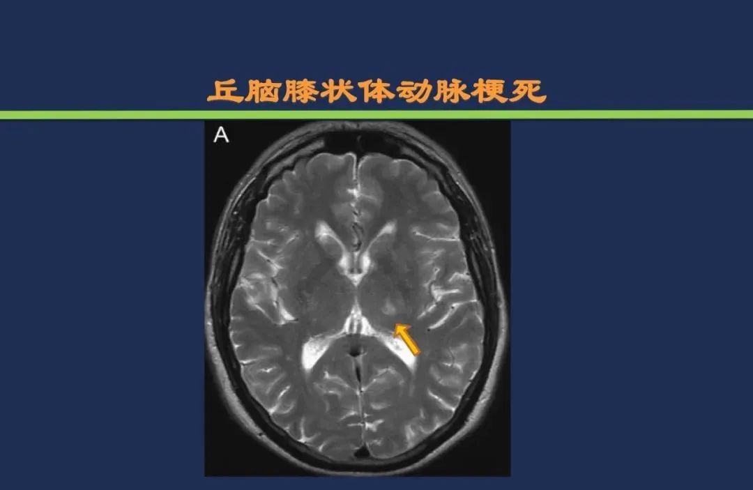 影像PPT - 从梗死部位推测责任血管:脑血管解剖-121 影像PPT - 从梗死部位推测责任血管:脑血管解剖-121