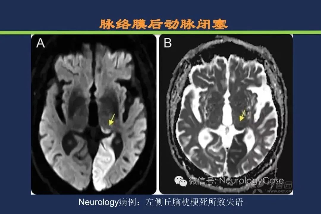 影像PPT - 从梗死部位推测责任血管:脑血管解剖-122 影像PPT - 从梗死部位推测责任血管:脑血管解剖-122