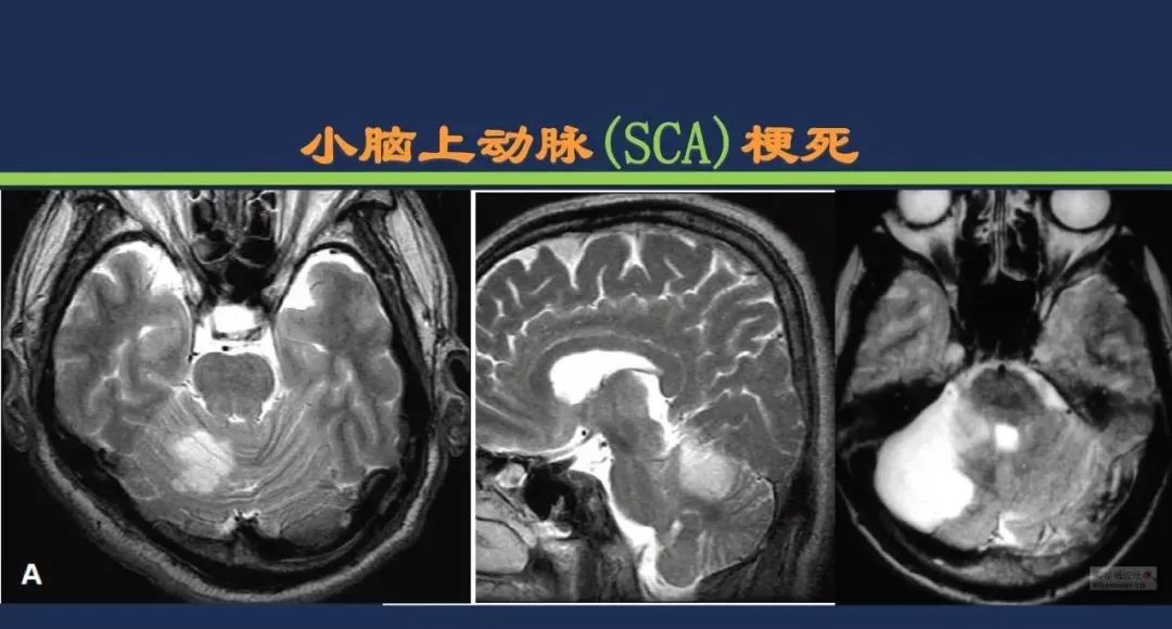 影像PPT - 从梗死部位推测责任血管:脑血管解剖-126 影像PPT - 从梗死部位推测责任血管:脑血管解剖-126