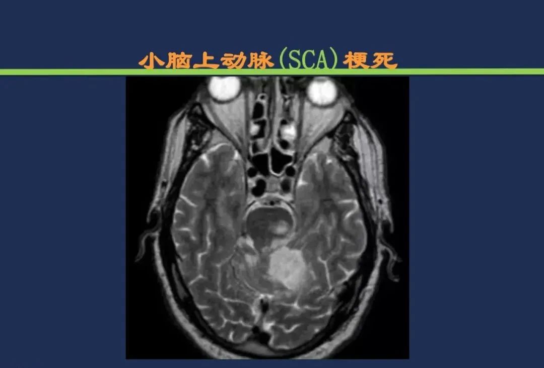 影像PPT - 从梗死部位推测责任血管:脑血管解剖-127 影像PPT - 从梗死部位推测责任血管:脑血管解剖-127