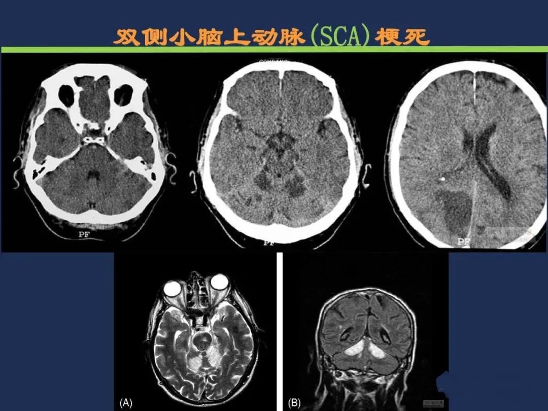 影像PPT - 从梗死部位推测责任血管:脑血管解剖-128 影像PPT - 从梗死部位推测责任血管:脑血管解剖-128